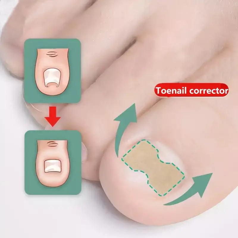 Ingrown Toenail Patches (100 Pcs)