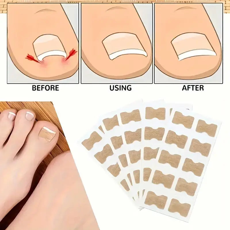 Ingrown Toenail Patches (100 Pcs)