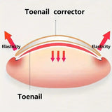 Ingrown Toenail Patches (100 pcs)