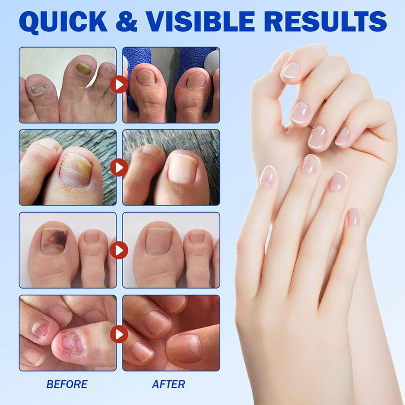 #1 Fungal Nail Patches