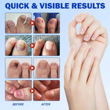 #1 Fungal Nail Patches