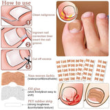 Ingrown Toenail Patches (100 pcs)