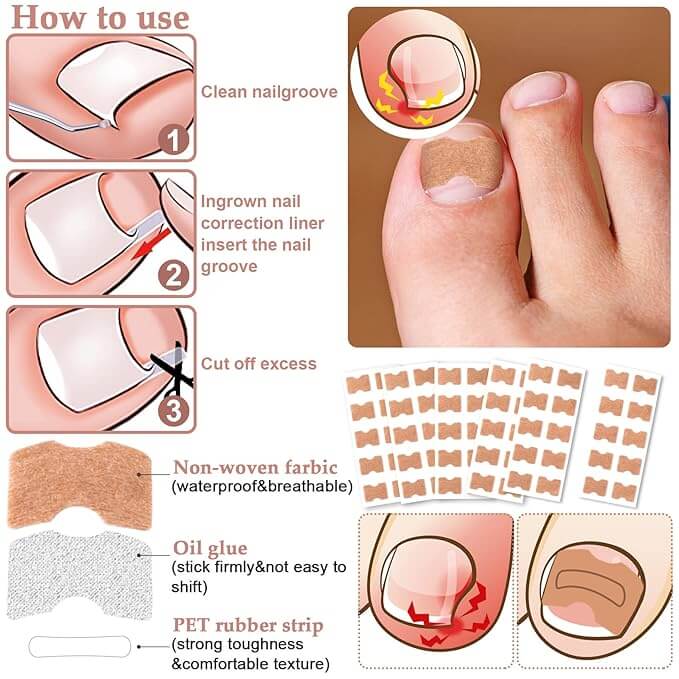 Ingrown Toenail Patches (100 pcs)