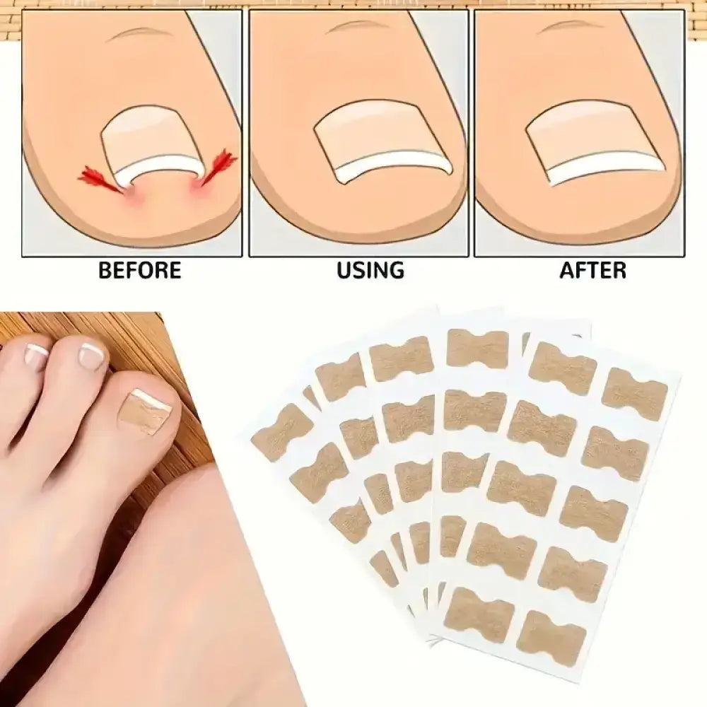 Ingrown Toenail Patches (100 Pcs)