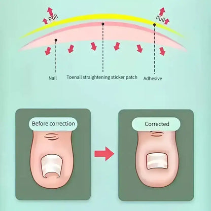 Ingrown Toenail Patches (100 Pcs)